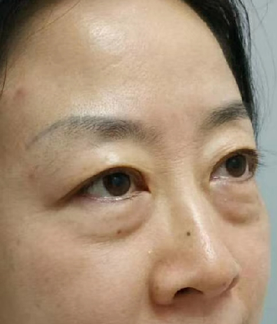 去眼袋手术