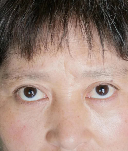 去眼袋手术