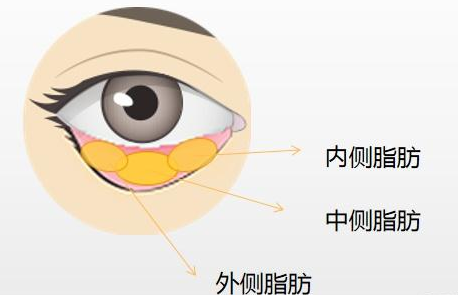 去眼袋手术