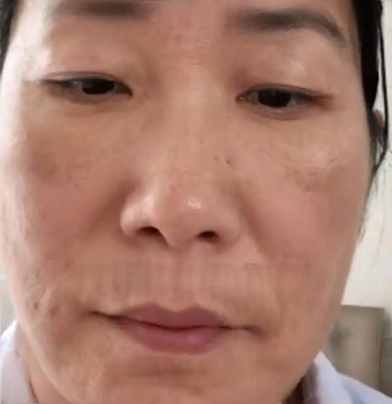 去眼袋手术