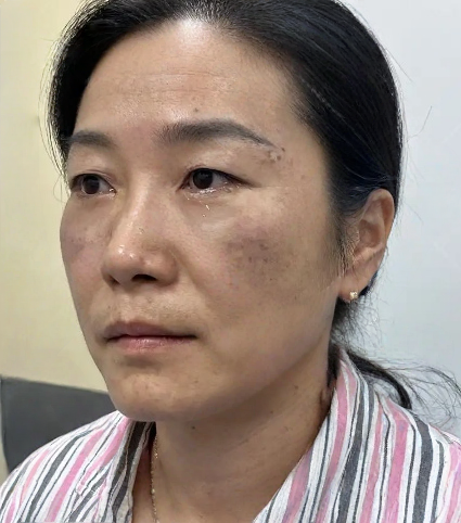 去眼袋手术