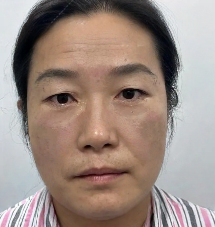 去眼袋手术