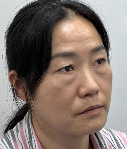 去眼袋手术