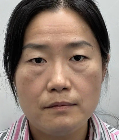 去眼袋手术