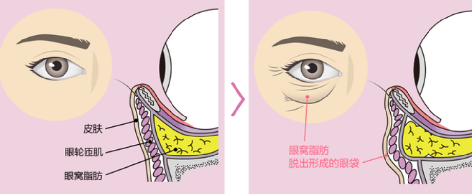 去眼袋手术