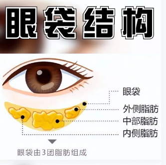 去眼袋手术