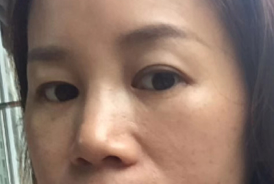 去眼袋手术