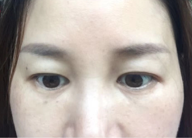 去眼袋手术