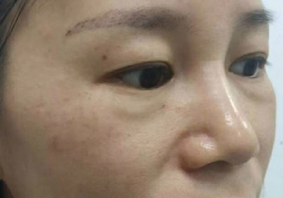 去眼袋手术