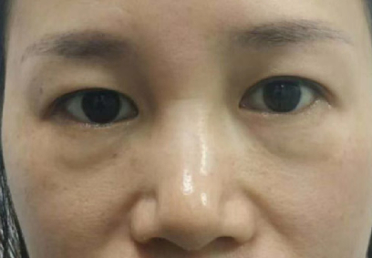 去眼袋手术