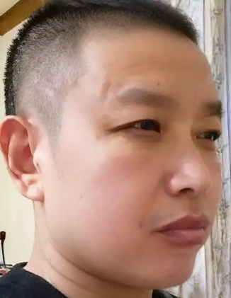 去眼袋手术