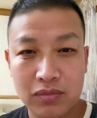 去眼袋手术