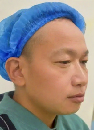 去眼袋手术