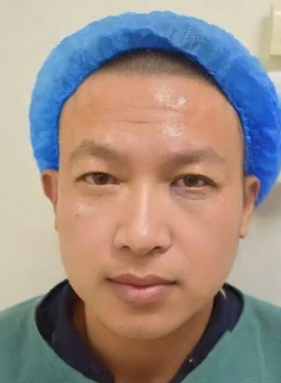去眼袋手术