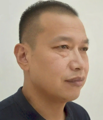 去眼袋手术