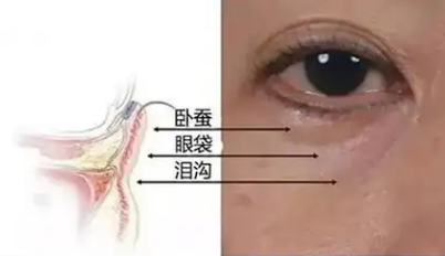 去眼袋手术