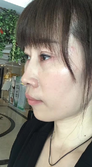 去眼袋手术