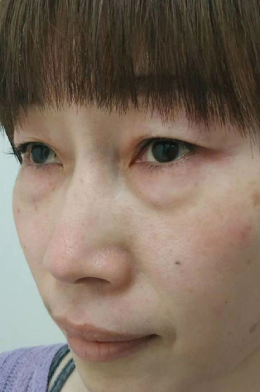 去眼袋手术