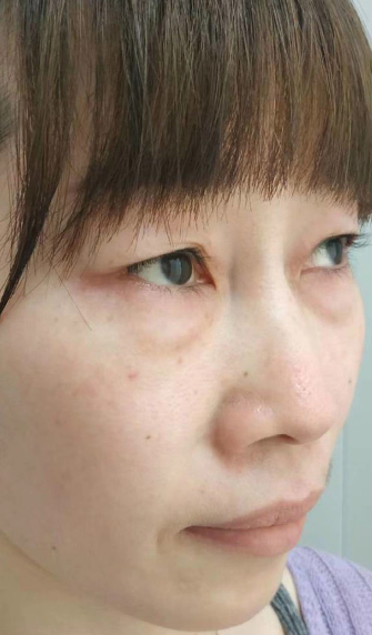 去眼袋手术