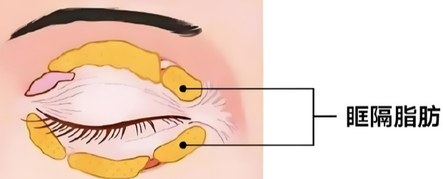 去眼袋手术