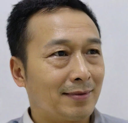 去眼袋手术
