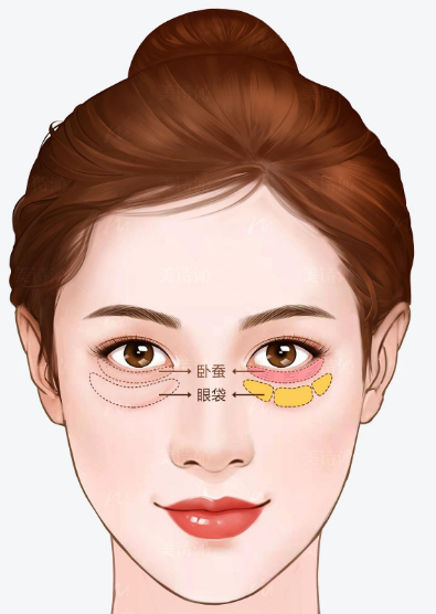 去眼袋手术