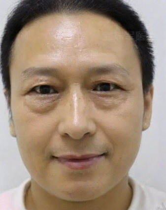 去眼袋手术