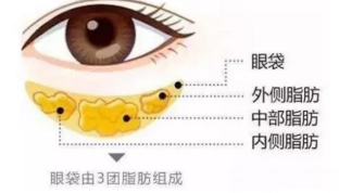 去眼袋手术