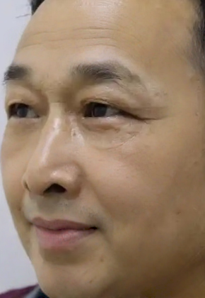 去眼袋手术