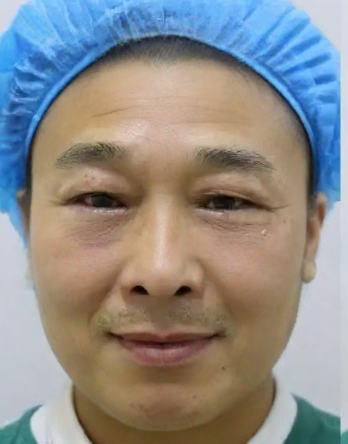 去眼袋手术