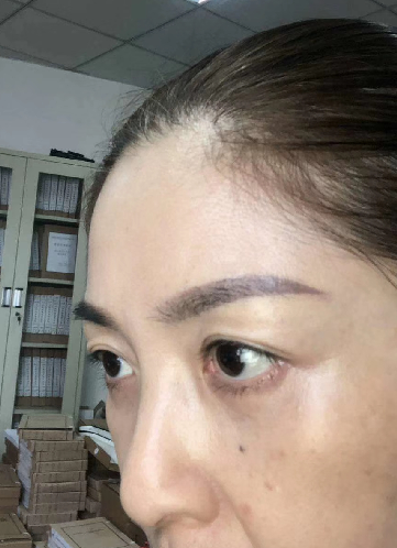 去眼袋手术