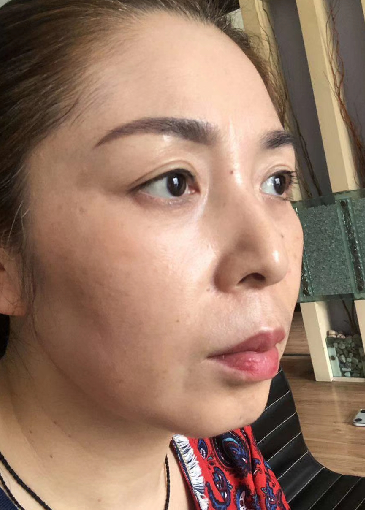 去眼袋手术