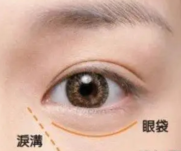 去眼袋手术