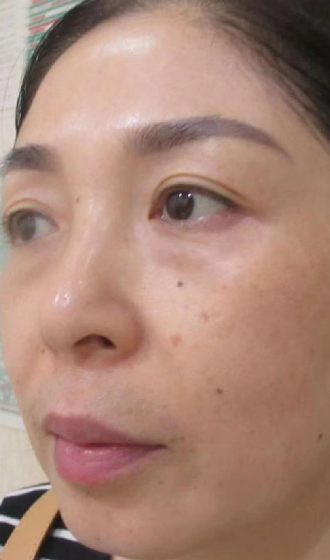去眼袋手术
