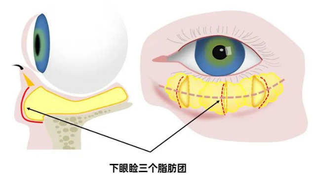 去眼袋手术