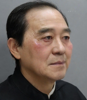去眼袋手术