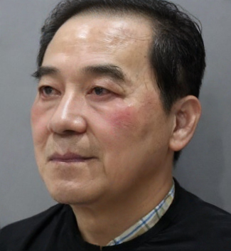 去眼袋手术