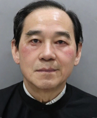 去眼袋手术
