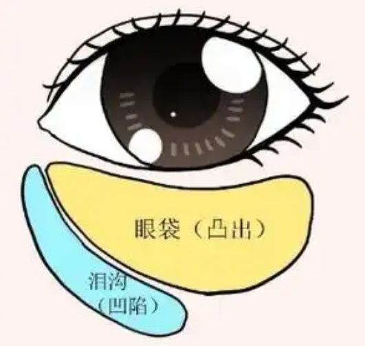 去眼袋手术