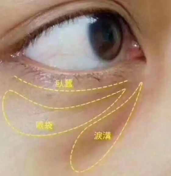 眼袋