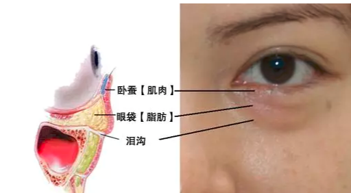 眼袋