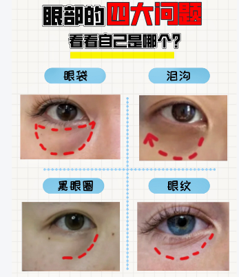 眼袋