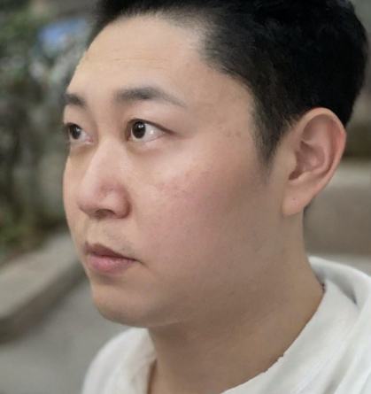 去眼袋手术