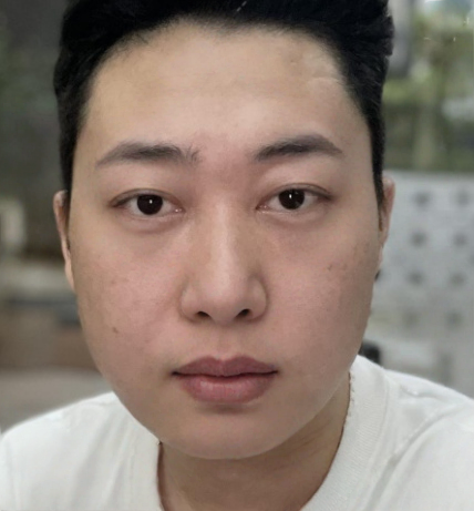 去眼袋手术