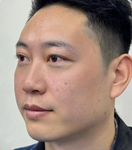 去眼袋手术