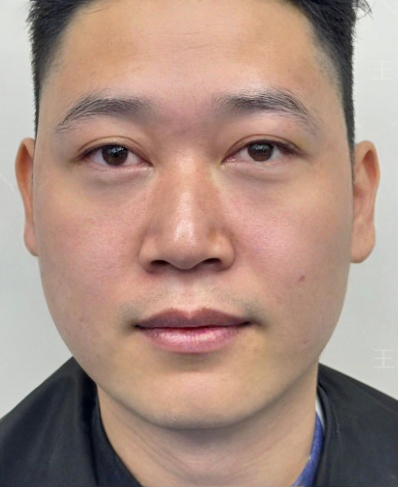 去眼袋手术