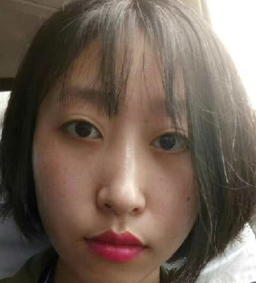 去眼袋手术