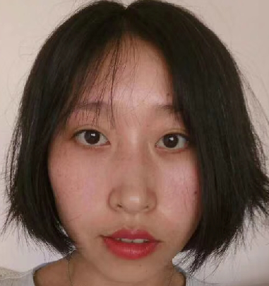 去眼袋手术