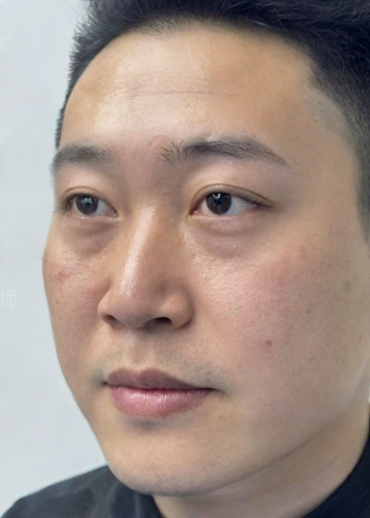 去眼袋手术