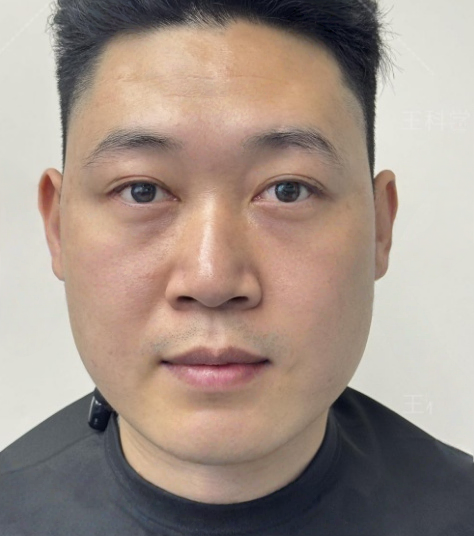 去眼袋手术